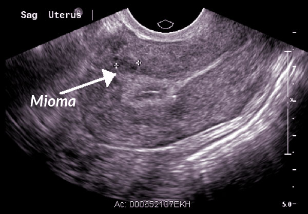 Mioma Infertilidad
