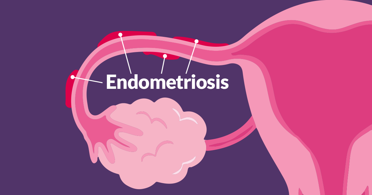 Endometriosis Clínica de Fertilidad