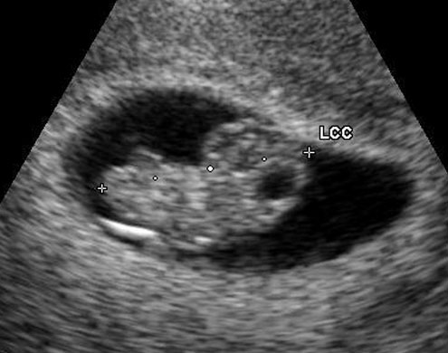 Embrion Embarazo
