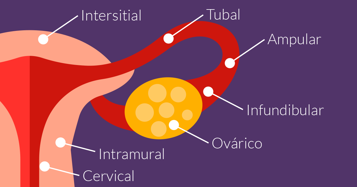 Embarazo Ectópico Fertilidad In Vitro