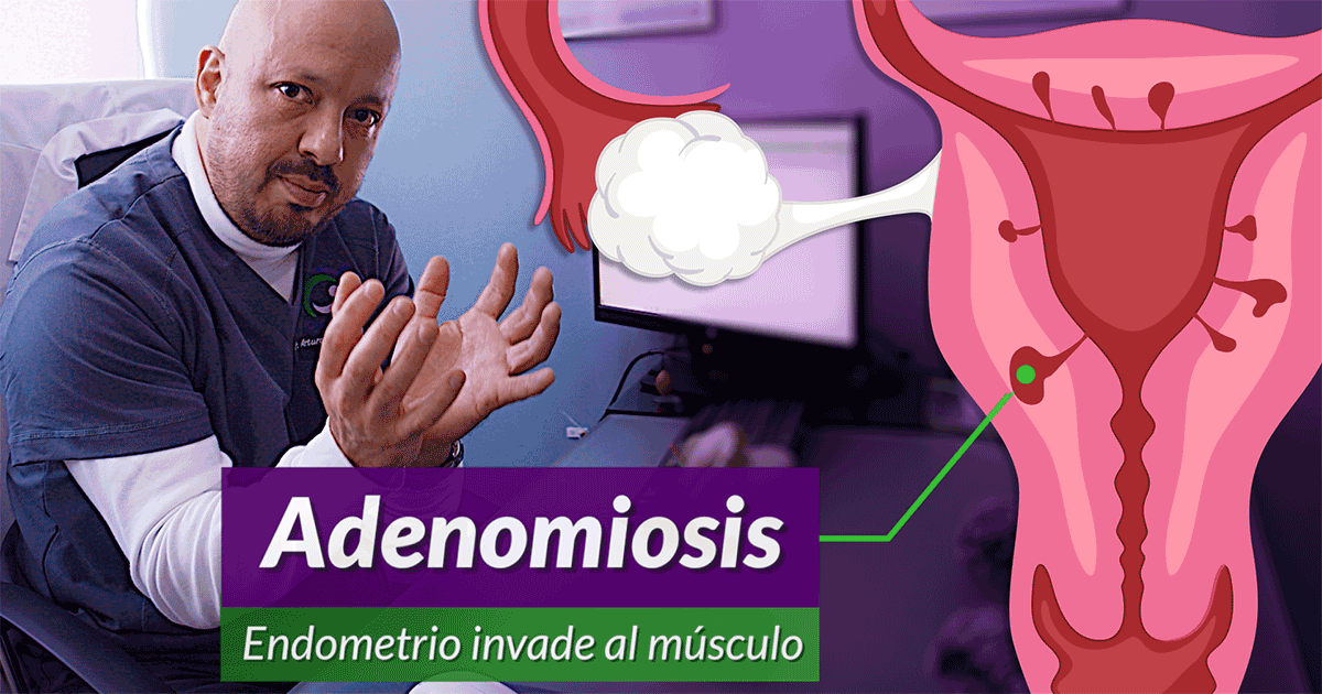 Cirugía Adenomiosis Endometriosis Mioma