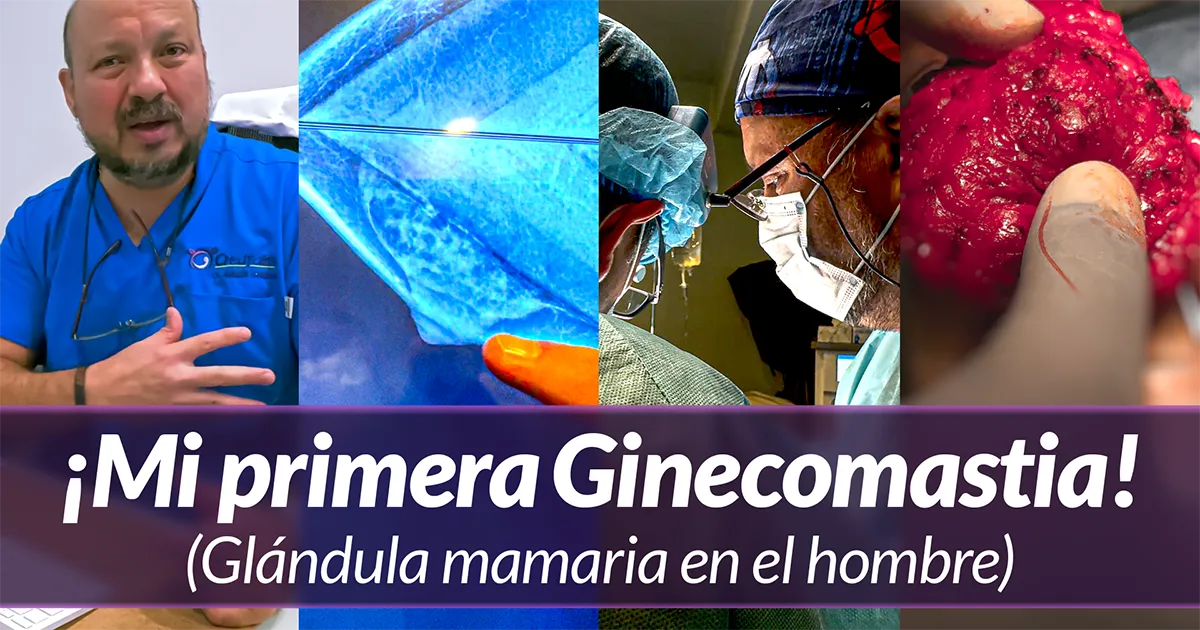 Ginecomastia Cirugía de glándula mamaria en hombres